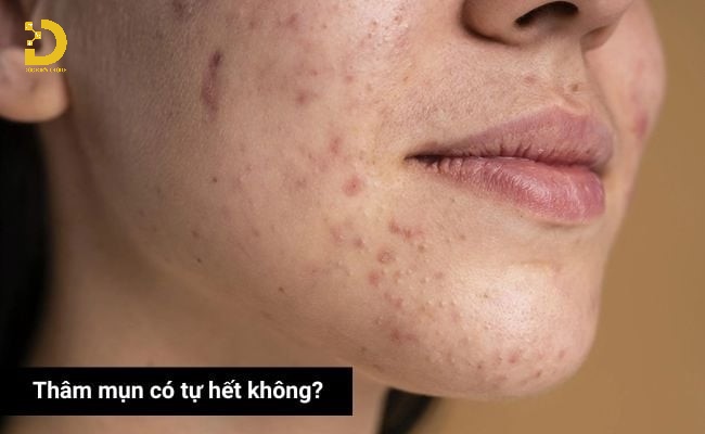 Thâm Mụn Có Tự Hết Không? Cách Phòng Ngừa Và Điều Trị Hiệu Quả 14 Thời gian để cơ thể tự mờ thâm mụn có thể kéo dài từ vài tuần đến vài tháng, thậm chí lâu hơn.
