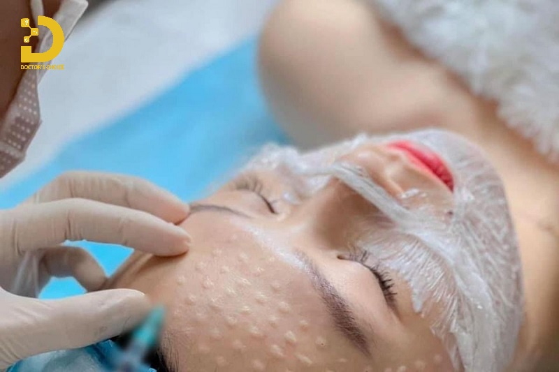 Top 9+ Phương Pháp Điều Trị Mụn Chuẩn Y Khoa Tốt Nhất 20 Tiêm Mesotherapy trị mụn