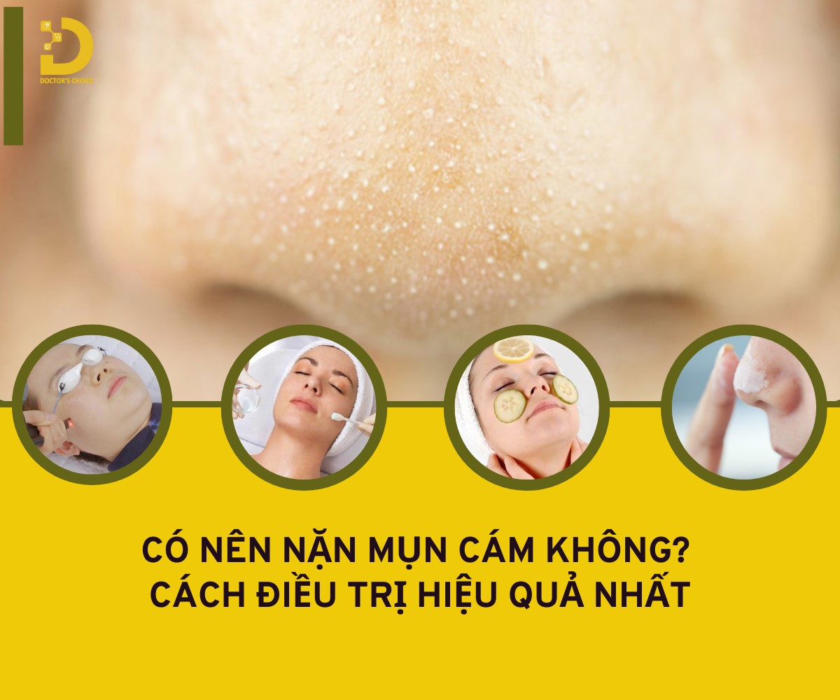 Mụn Cám: Nguyên Nhân, Cách Nặn Mụn & Điều Trị Hiệu Quả 9 Tìm hiểu về mụn cám và cách điều trị hiệu quả