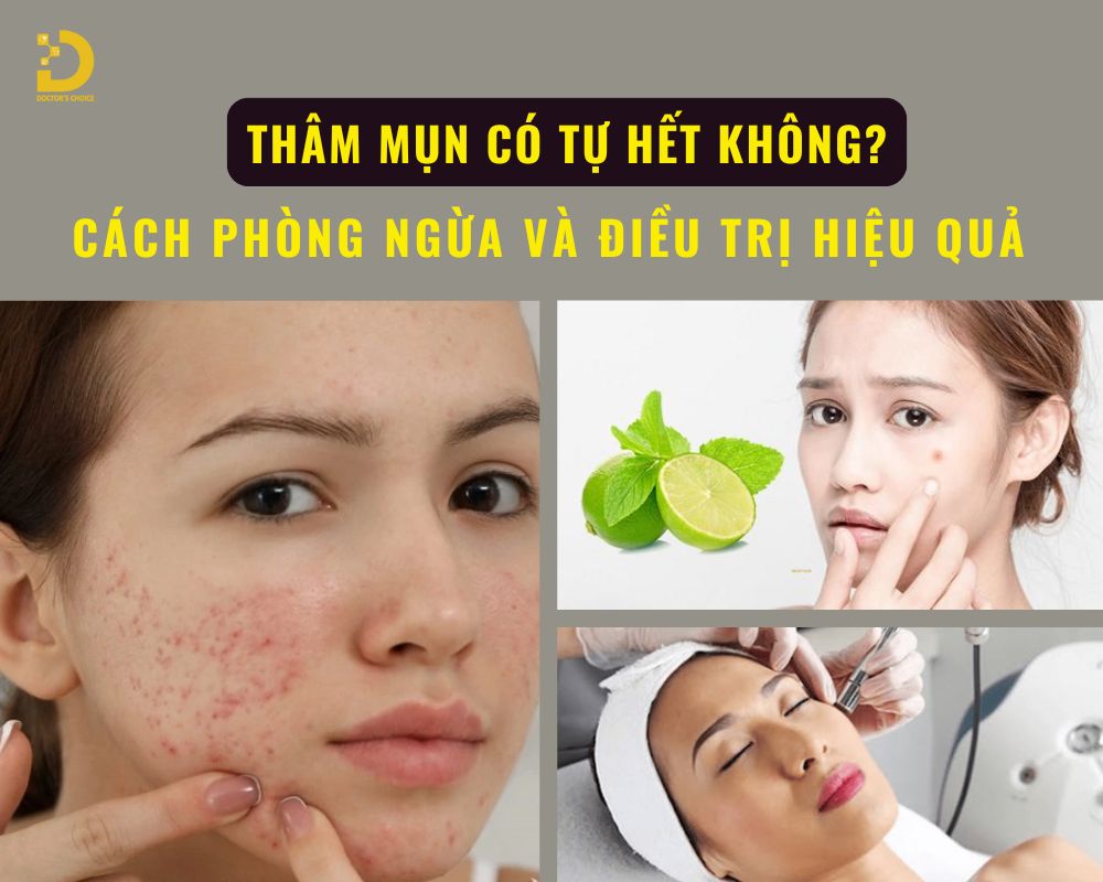 Thâm Mụn Có Tự Hết Không? Cách Phòng Ngừa Và Điều Trị Hiệu Quả 12 Tìm hiểu về thâm mụn và cách điều trị