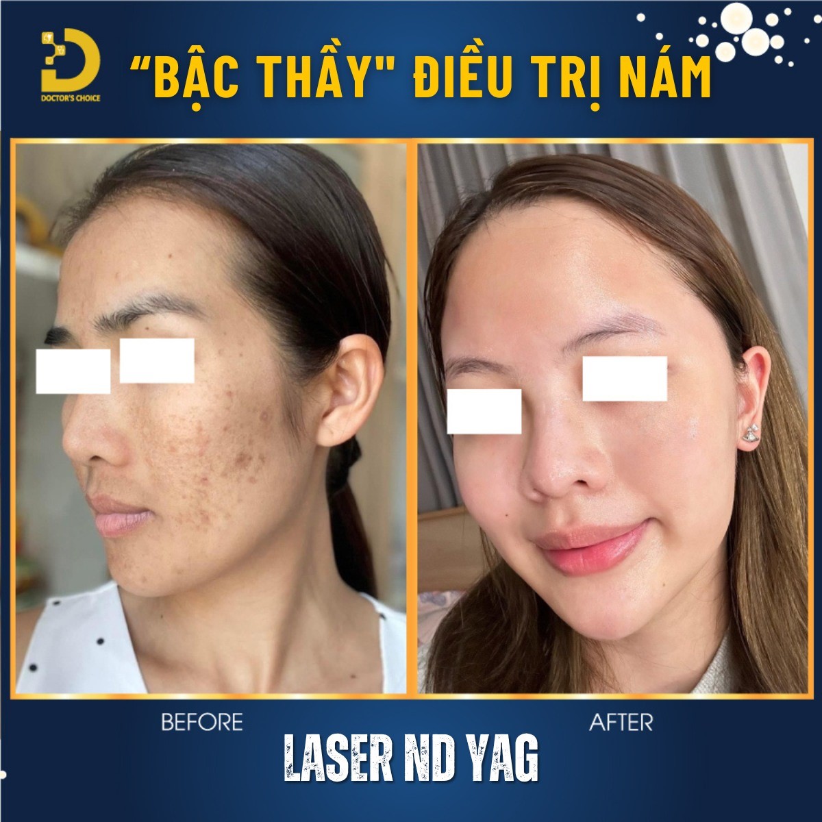 Trẻ Hóa Da Bằng Laser: Ưu Nhược Điểm, Công Nghệ Nào Tốt? 11 tre hoa da bang cong nghe laser 4