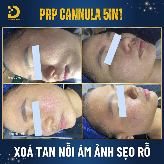Trẻ Hóa Da Bằng PRP Là Gì? Ưu Nhược Điểm, Có Nên Làm? 15 tre hoa da bang prp 6