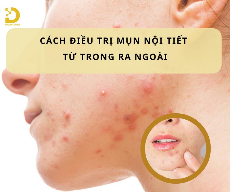 Cách Điều Trị Mụn Nội Tiết Từ Trong Ra Ngoài 7 Cách điều trị mụn nội tiết từ trong ra ngoài hiệu quả