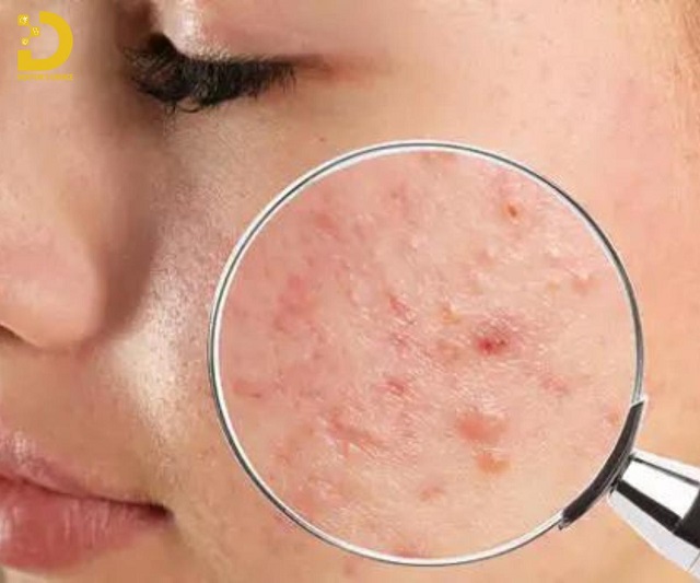 Cách Điều Trị Mụn Nội Tiết Từ Trong Ra Ngoài 8 tri mun noi tiet 2