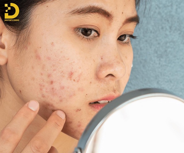 Cách Điều Trị Mụn Nội Tiết Từ Trong Ra Ngoài 9 tri mun noi tiet 3