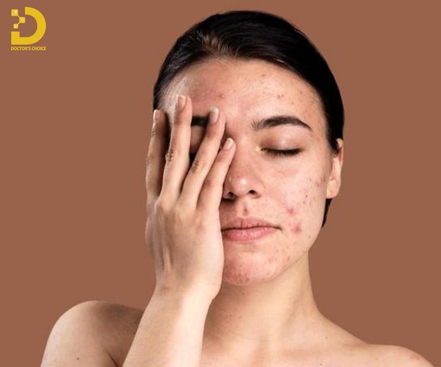 Cách Điều Trị Mụn Nội Tiết Từ Trong Ra Ngoài 10 tri mun noi tiet 4