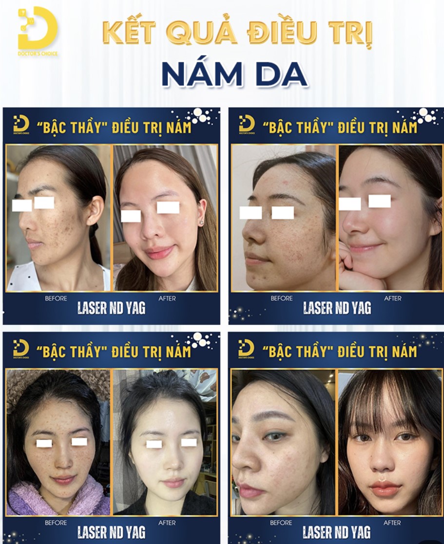 Trị Nám Bằng Laser: Ưu Nhược Điểm, Công Nghệ Nào Tốt? 14 Kết quả điều trị nám bằng laser