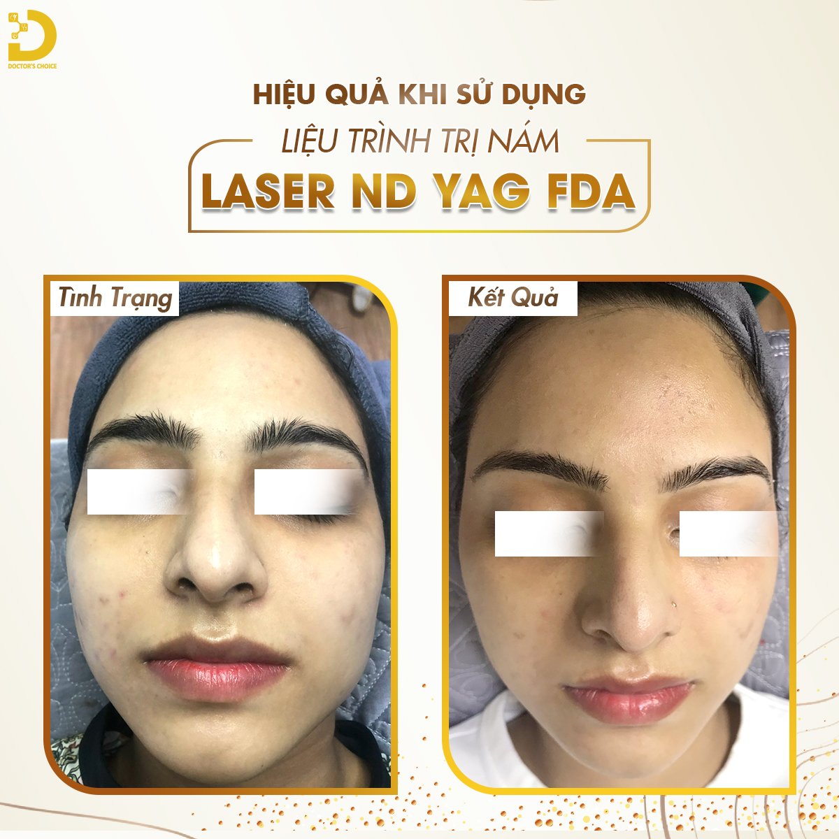 Trị Nám Bằng Laser: Ưu Nhược Điểm, Công Nghệ Nào Tốt? 11 Trị nám bằng laser mang lại nhiều hiệu quả