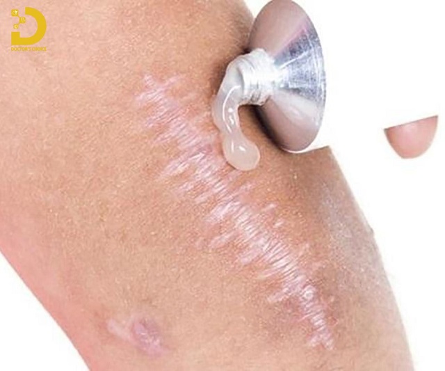 Review Các Phương Pháp Điều Trị Sẹo Chuẩn Y Khoa 16 tri seo chuan y khoa 2