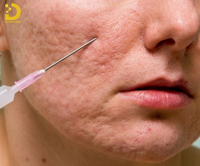 Review Các Phương Pháp Điều Trị Sẹo Chuẩn Y Khoa 21 tri seo chuan y khoa 7