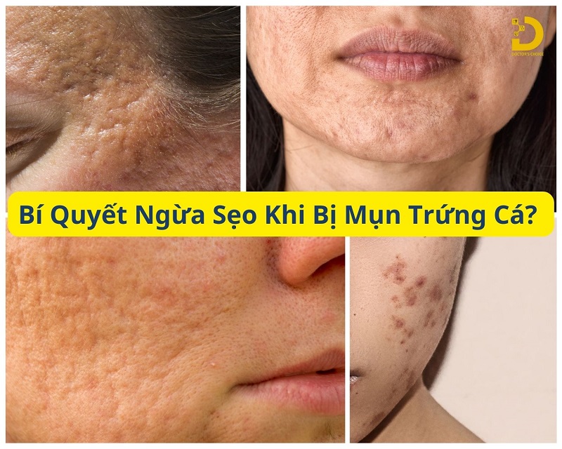 Bí Quyết Ngăn Ngừa Sẹo Khi Bị Mụn Trứng Cá 8 Cách ngăn ngừa sẹo khi bị mụn trứng cá