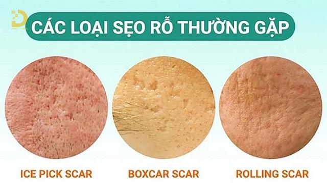 Bí Quyết Ngăn Ngừa Sẹo Khi Bị Mụn Trứng Cá 9 tri seo do mun trung ca 2