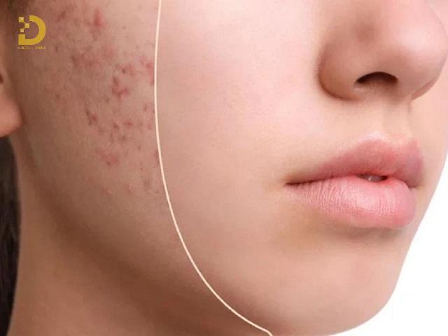 Bí Quyết Ngăn Ngừa Sẹo Khi Bị Mụn Trứng Cá 10 tri seo do mun trung ca 3