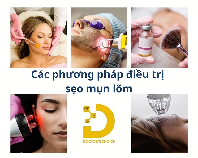 Bí Quyết Ngăn Ngừa Sẹo Khi Bị Mụn Trứng Cá 11 tri seo do mun trung ca 4