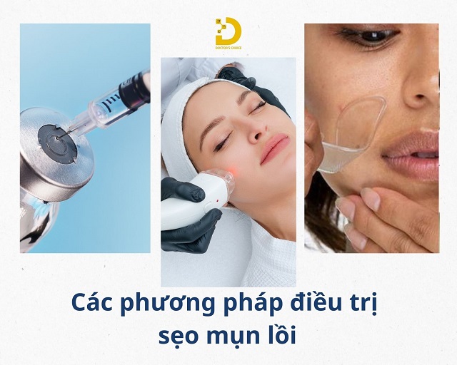 Bí Quyết Ngăn Ngừa Sẹo Khi Bị Mụn Trứng Cá 12 tri seo do mun trung ca 5