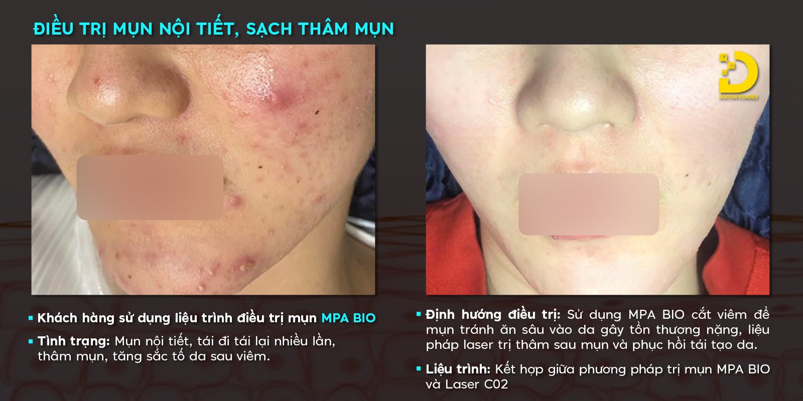 Trị Thâm Bằng Laser: Ưu Nhược Điểm, Công Nghệ Nào Tốt? 14 Hình ảnh kết quả trị thâm mụn