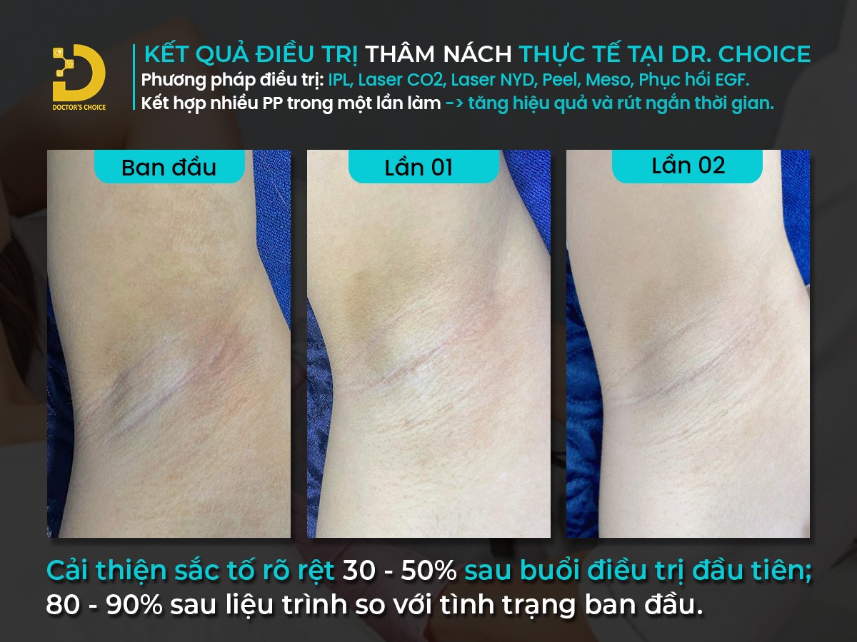 Trị Thâm Bằng Laser: Ưu Nhược Điểm, Công Nghệ Nào Tốt? 15 Kết quả trị thâm nách bằng công nghệ laser