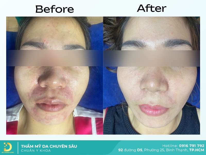 Dịch Vụ Chăm Sóc, Điều Trị, Thẩm Mỹ Da Chuẩn Y Khoa TP. HCM 45 Trị sẹo