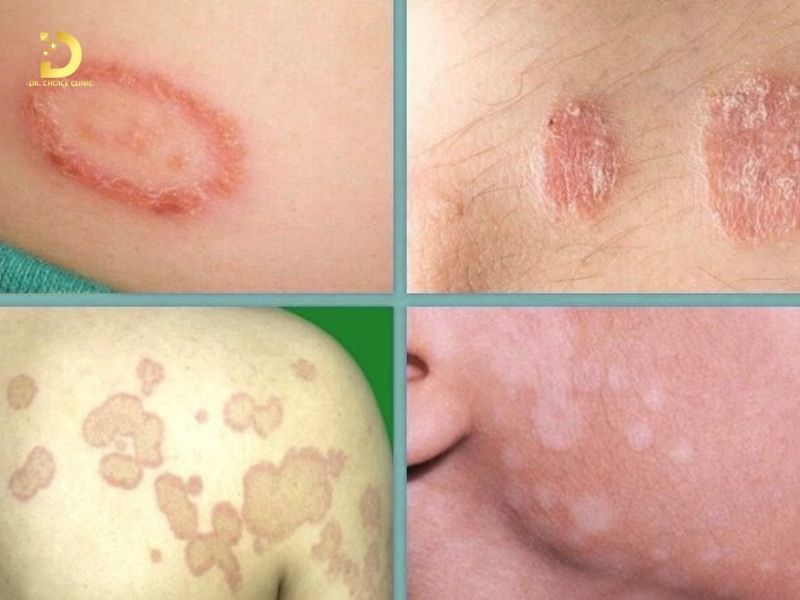 Phòng khám điều trị bệnh nấm da ở TPHCM hiệu quả, an toàn 9 Hình ảnh bệnh nấm da