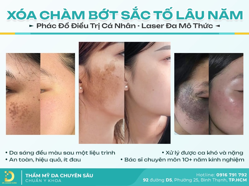 Phòng khám điều trị bớt sắc tố da tại TPHCM hiệu quả 23 bớt sắc tố da