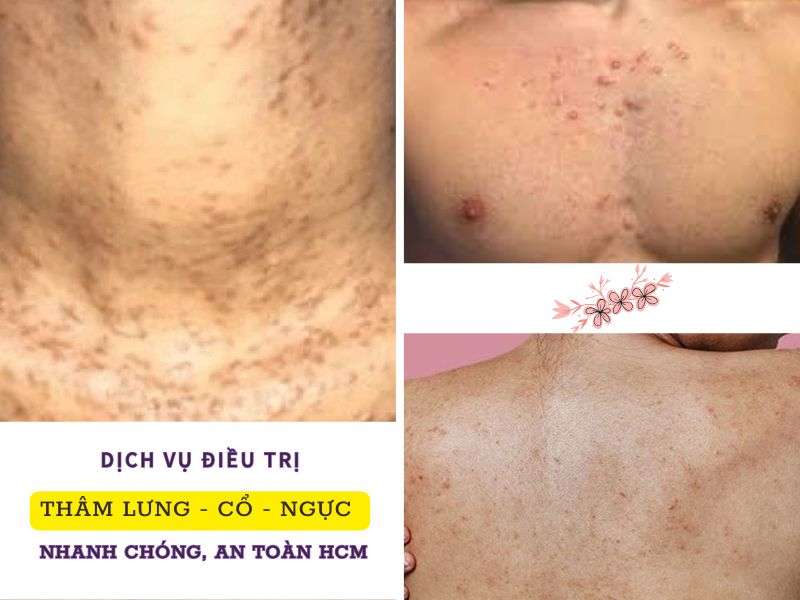 Phòng Khám Điều Trị Thâm Lưng - Cổ Ở HCM An Toàn 5 Dịch vụ điều trị thâm lưng - cổ - ngực