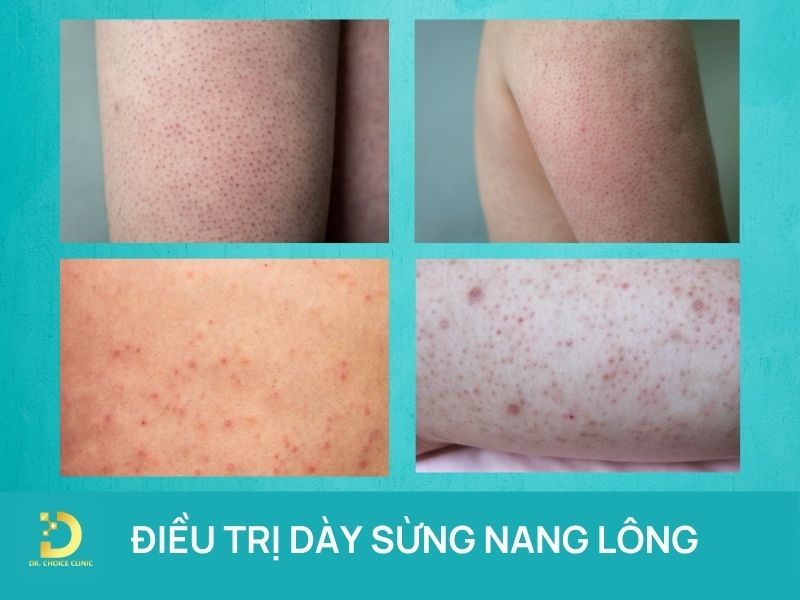 Phòng Khám Điều Trị Dày Sừng Nang Lông Hiệu Quả Tại TPHCM 7 Điều trị dày sừng nang lông chuẩn y khoa tại HCM