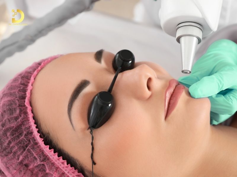 Phòng Khám Điều Trị Hạt Fordyce Chuẩn Y Khoa Tại TPHCM 10 Điều trị hạt Fordyce bằng laser