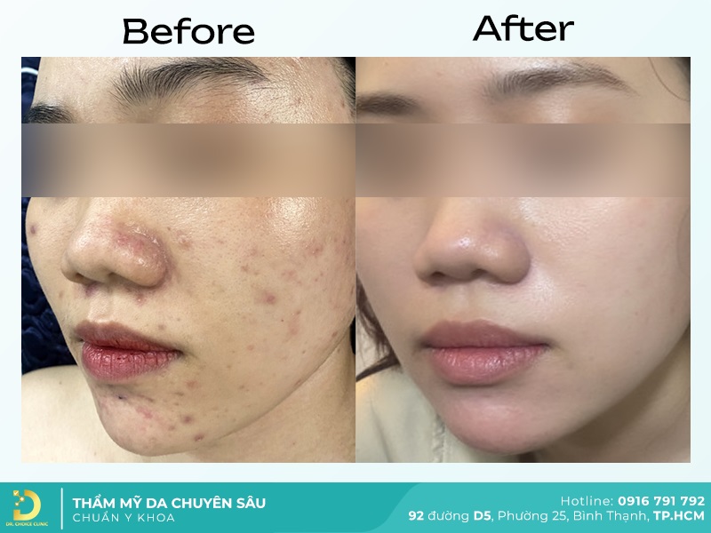 Giới Thiệu Về Dr. Choice Clinic 27 dieu tri mun 1