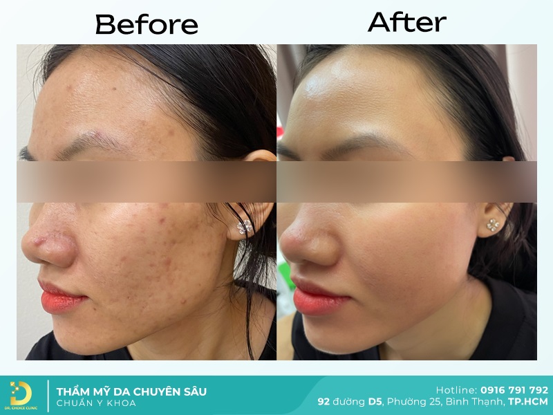 Giới Thiệu Về Dr. Choice Clinic 28 dieu tri mun 2