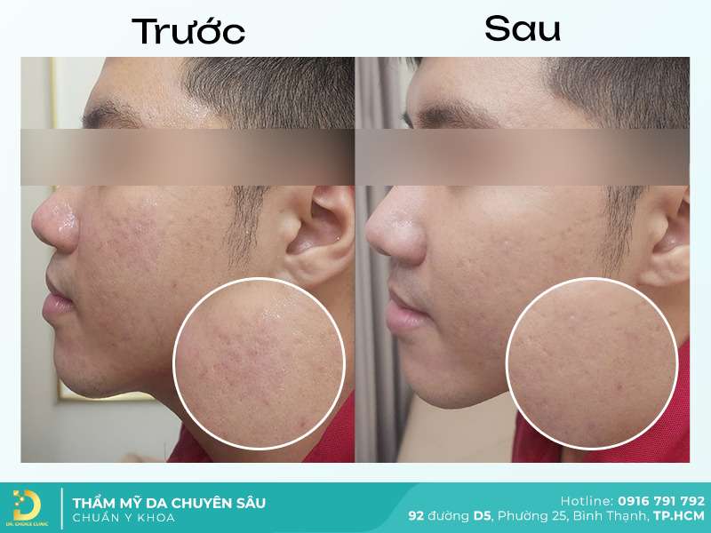 Dịch Vụ Chăm Sóc, Điều Trị, Thẩm Mỹ Da Chuẩn Y Khoa TP. HCM 53 Điều trị mụn