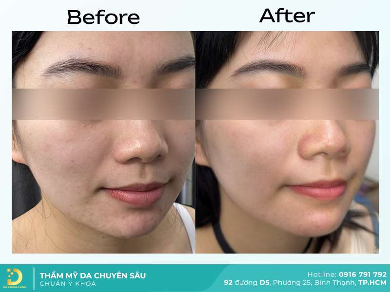 Dịch Vụ Chăm Sóc, Điều Trị, Thẩm Mỹ Da Chuẩn Y Khoa TP. HCM 54 Điều trị mụn