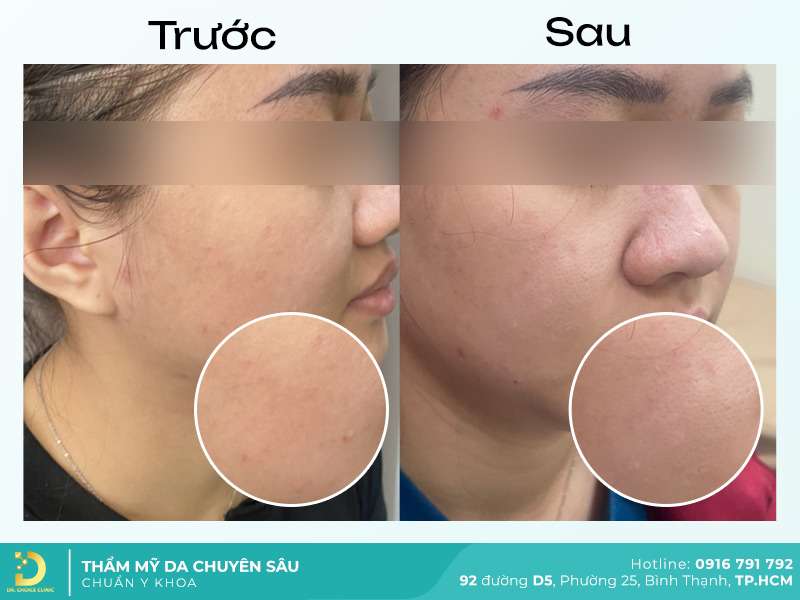 Dịch Vụ Chăm Sóc, Điều Trị, Thẩm Mỹ Da Chuẩn Y Khoa TP. HCM 55 Điều trị mụn