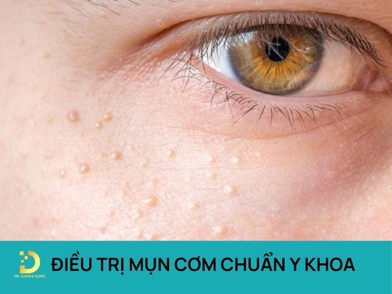 Phòng Khám Điều Trị Mụn Cơm Hiệu Quả, Chuẩn Y Khoa Tại HCM 7 Điều trị mụn cơm chuẩn y khoa tại HCM