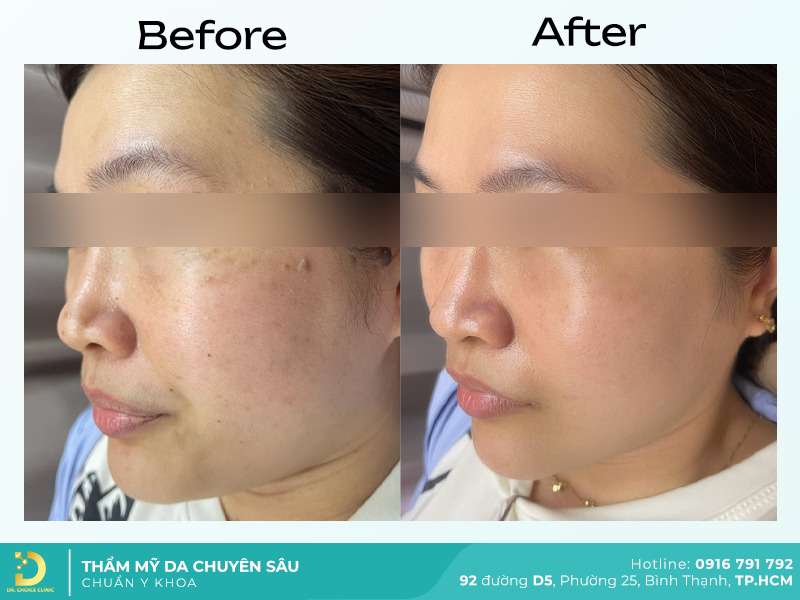 Dịch Vụ Chăm Sóc, Điều Trị, Thẩm Mỹ Da Chuẩn Y Khoa TP. HCM 57 Điều trị mụn