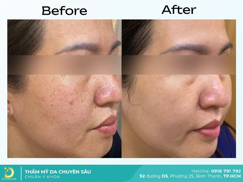 Dịch Vụ Chăm Sóc, Điều Trị, Thẩm Mỹ Da Chuẩn Y Khoa TP. HCM 58 Điều trị mụn