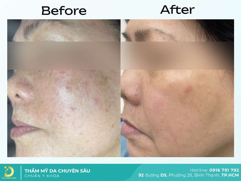 Dịch Vụ Chăm Sóc, Điều Trị, Thẩm Mỹ Da Chuẩn Y Khoa TP. HCM 59 Điều trị mụn