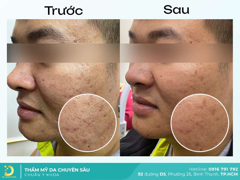 Dịch Vụ Chăm Sóc, Điều Trị, Thẩm Mỹ Da Chuẩn Y Khoa TP. HCM 60 Điều trị mụn