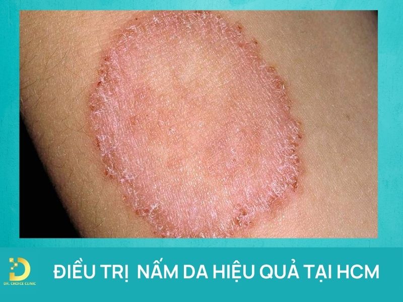 Phòng khám điều trị bệnh nấm da ở TPHCM hiệu quả, an toàn 8 Điều trị nấm da hiệu quả tại HCM