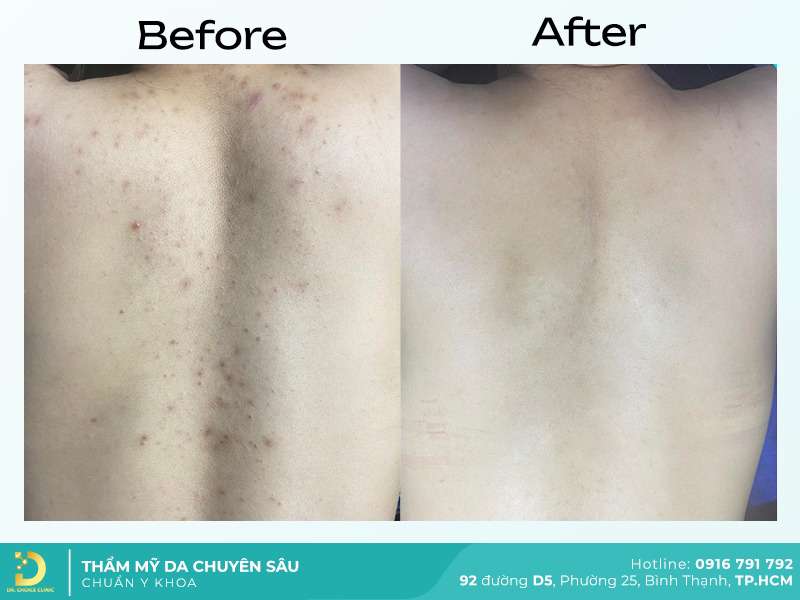 Dịch Vụ Chăm Sóc, Điều Trị, Thẩm Mỹ Da Chuẩn Y Khoa TP. HCM 41 Trị thâm lưng.
