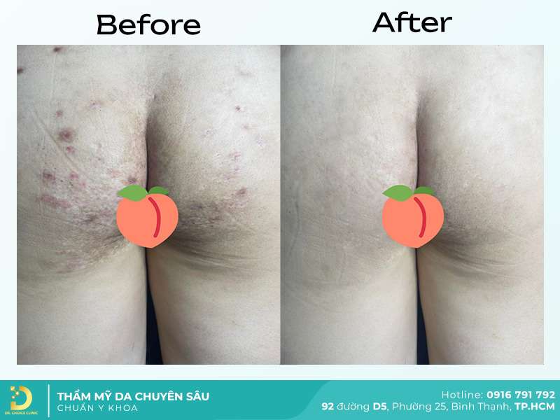 Dịch Vụ Chăm Sóc, Điều Trị, Thẩm Mỹ Da Chuẩn Y Khoa TP. HCM 40 Trị thâm mông.
