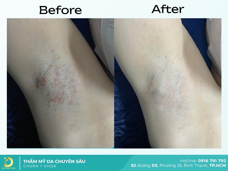 Giới Thiệu Về Dr. Choice Clinic 24 dieu tri tham 1