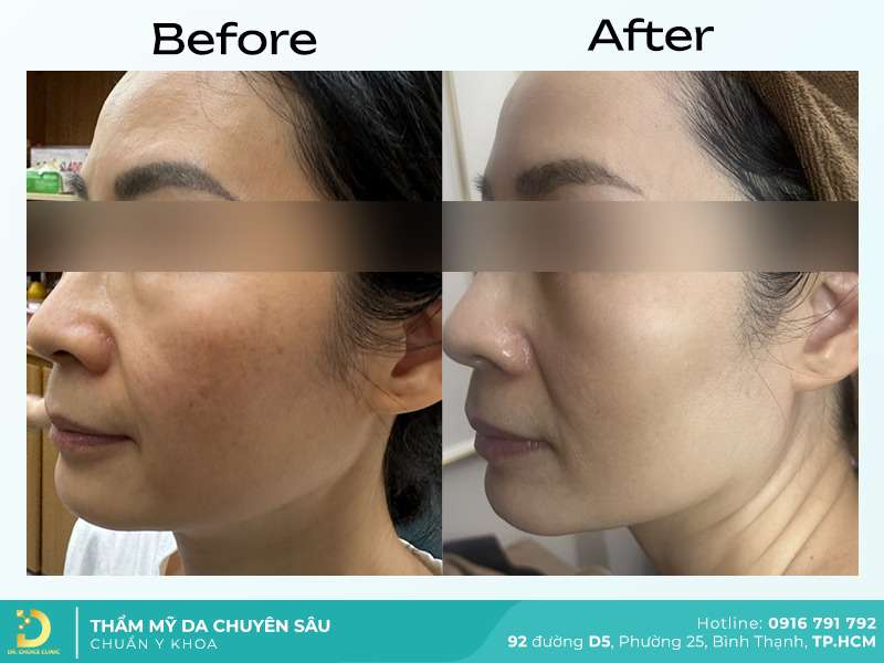 Dịch Vụ Chăm Sóc, Điều Trị, Thẩm Mỹ Da Chuẩn Y Khoa TP. HCM 43 Trị thâm mắt.
