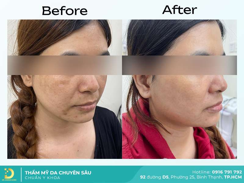 Dịch Vụ Chăm Sóc, Điều Trị, Thẩm Mỹ Da Chuẩn Y Khoa TP. HCM 44 Trị thâm mắt.