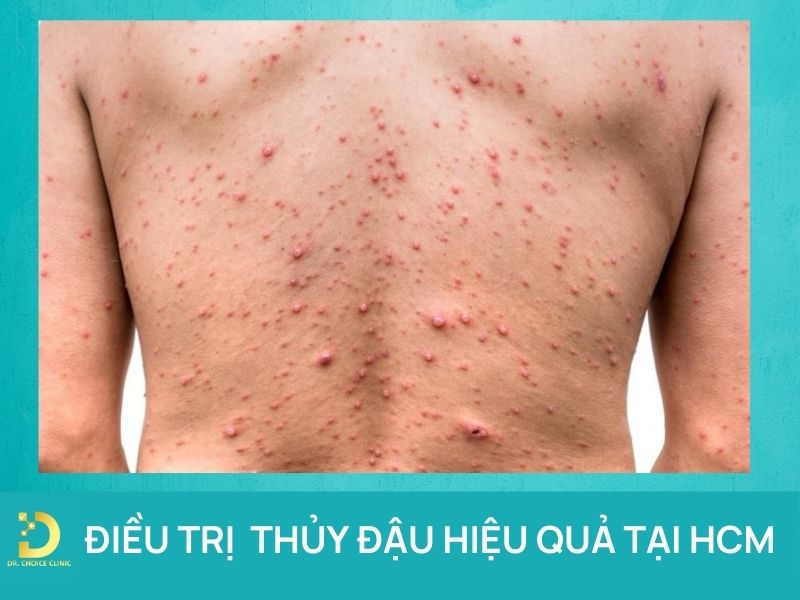 Phòng khám điều trị thủy đậu tại TPHCM an toàn, hiệu quả 7 Điều trị thủy đậu an toàn hiệu quả tại HCM