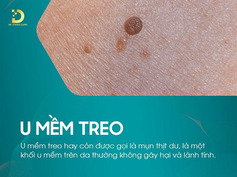 Phòng Khám Điều Trị U Treo Mềm An Toàn, Hiện Quả Ở TPHCM 6 Dịch vụ điều trị u mềm treo