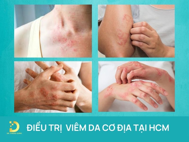 Phòng khám điều trị viêm da cơ địa (chàm) TPHCM uy tín 6 Điều trị viêm da cơ địa