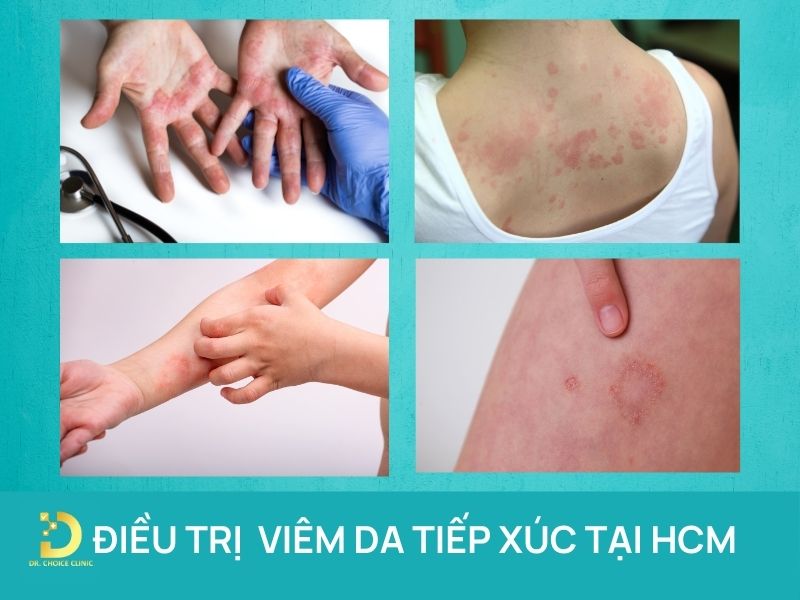 Phòng Khám Điều Trị Viêm Da Tiếp Xúc Hiệu Quả, An Toàn Tại TPHCM 7 Điều trị viêm da tiếp xúc tại HCM