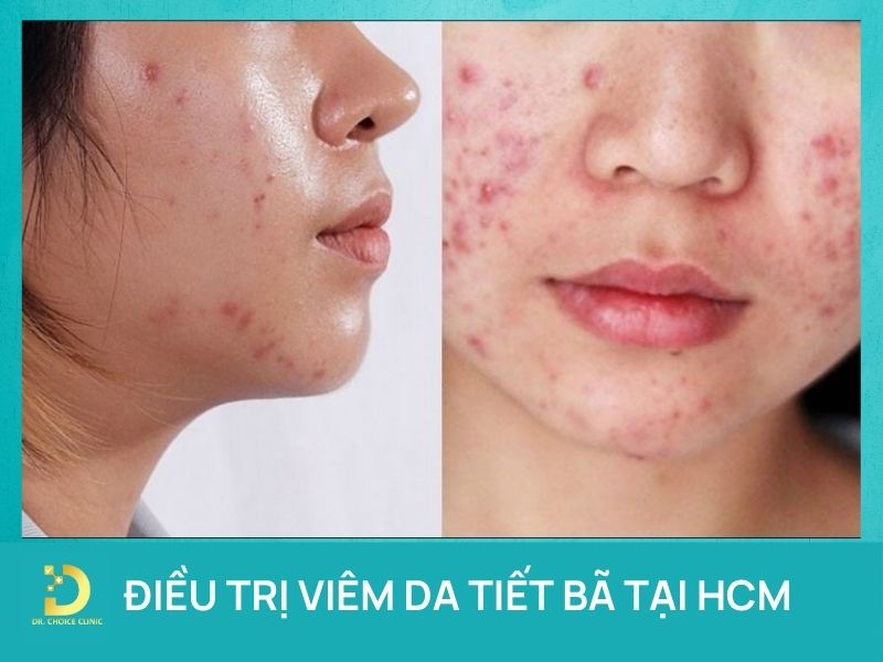 Phòng Khám Điều Trị Viêm Da Tiết Bã Chuẩn Y Khoa Tại HCM 7 Điều trị viêm da tiết bã chuẩn y khoa tại HCM