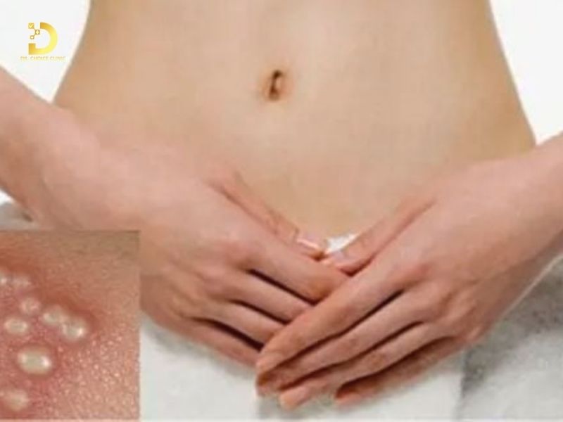 Phòng Khám Điều Trị Hạt Fordyce Chuẩn Y Khoa Tại TPHCM 8 Hạt Fordyce thường xuất hiện vùng kín