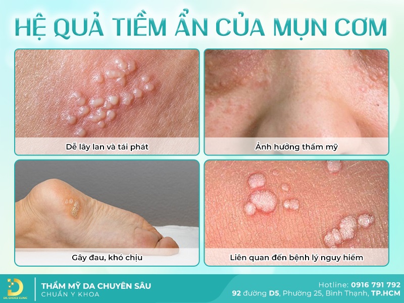 Phòng Khám Điều Trị Mụn Cơm Hiệu Quả, Chuẩn Y Khoa Tại HCM 9 Hệ quả tiềm ẩn của mụn ẩn
